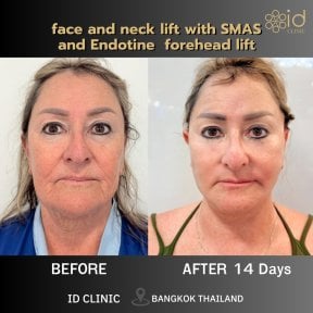 Before and after face and neck lift with SMAS at ID Clinic Bangkok, visible rejuvenation result