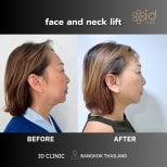 Before and after facelift and neck lift results at ID Clinic Bangkok, visible skin tightening