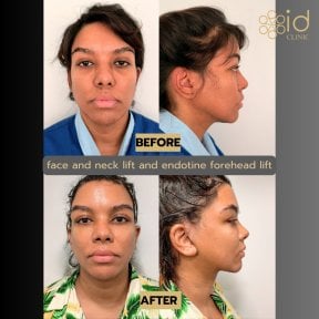 Before and after facelift, neck lift, and endotine forehead lift results at ID Clinic Bangkok