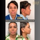Before and after facelift, neck lift, and endotine forehead lift results at ID Clinic Bangkok