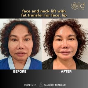 Before and after facelift and neck lift with fat transfer at ID Clinic Bangkok, visible results