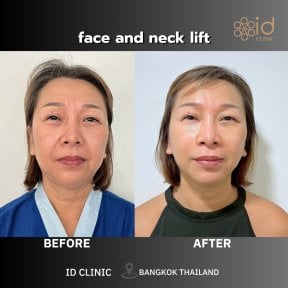 Before and after facelift and neck lift results at ID Clinic Bangkok, visible rejuvenation