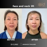 Before and after facelift and neck lift results at ID Clinic Bangkok, visible rejuvenation