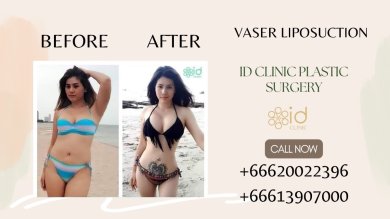Vorher-nachher-Ergebnisse der VASER-Liposuktion bei ID Clinic Bangkok, sichtbare Körperkontur