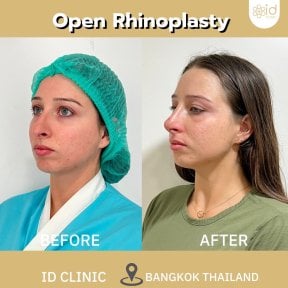 Before and after open rhinoplasty results at ID Clinic Bangkok, nose reshaping improvement