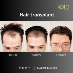 FUE hair transplant before and after results at ID Clinic Bangkok, visible hairline improvement