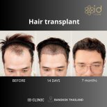 FUE hair transplant before and after results at ID Clinic Bangkok, visible hairline improvement