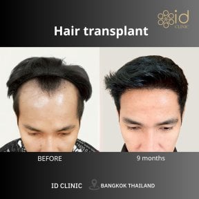 Before and after FUE hair transplant result at ID Clinic Bangkok, fuller hairline in 9 months