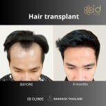 Before and after FUE hair transplant result at ID Clinic Bangkok, fuller hairline in 9 months