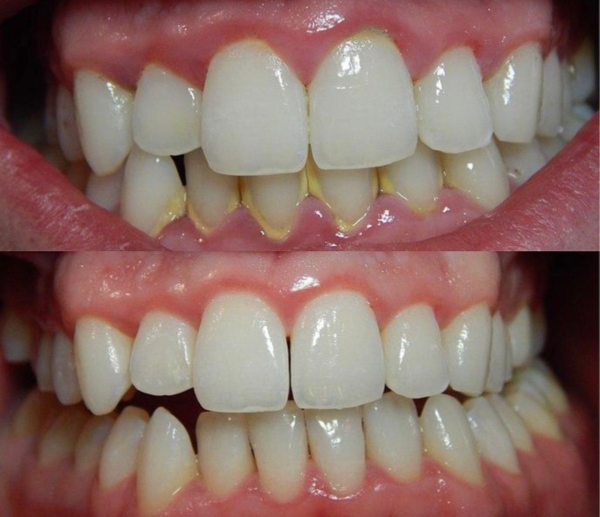 Resultados de blanqueamiento dental láser antes y después en Grand Dental Hospital & Laboratory