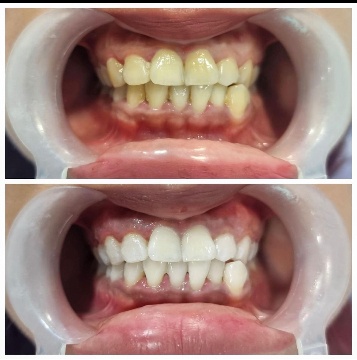 Resultados antes y después del blanqueamiento dental láser en Grand Dental Hospital & Laboratory