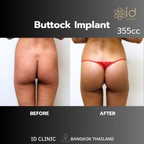 before-after photo buttock-lift