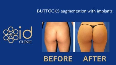 before-after photo buttock-lift