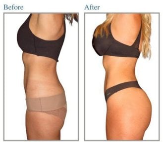 before-after photo buttock-lift