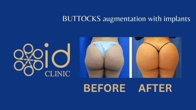 before-after photo buttock-lift