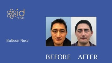 before-after photo rhinoplasty-nose-job