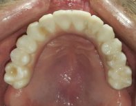 All-on-4 Zahnimplantat Ergebnis bei SoftDentalCare Clinic, restaurierter Oberkieferbogen