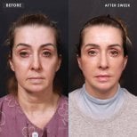Vorher-nachher-Ergebnis des endoskopischen Facelifts bei VG Plastic Surgery, sichtbare Verjüngung
