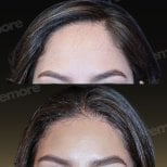 Forehead lift before and after results at Memorial Bahçelievler Hospital, smoother forehead
