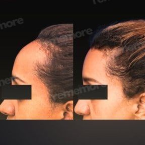 Forehead lift before and after results at Memorial Bahçelievler Hospital, smoother forehead contour