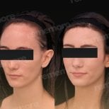 Forehead lift before and after results at Memorial Bahçelievler Hospital, smoother brow area