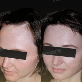 Forehead lift before and after results at Memorial Bahçelievler Hospital, smoother forehead skin