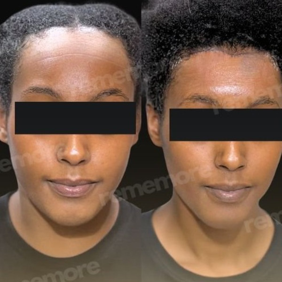 Resultados de lifting de frente antes y después en Memorial Bahçelievler Hospital, piel más lisa