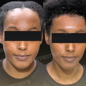 Forehead lift before and after results at Memorial Bahçelievler Hospital, smoother forehead skin