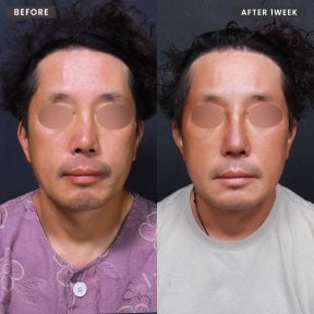 Результаты ринопластики до и после в VG Plastic Surgery, изменение носа через 1 неделю