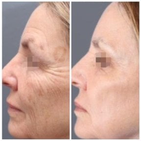 Résultats avant et après traitement laser CO2 chez Alpha Beauty Hannover, rajeunissement facial