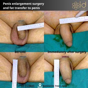 Vorher-nachher-Ergebnisse Penisvergrößerung mit Fetttransfer bei ID Clinic Bangkok