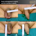 Vorher-nachher-Ergebnisse Penisvergrößerung mit Fetttransfer bei ID Clinic Bangkok