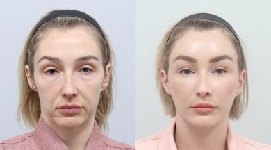Facelift before and after results at AB Plastic Surgery Clinic, visible facial rejuvenation