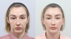 Facelift before and after results at AB Plastic Surgery Clinic, visible facial rejuvenation
