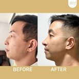 Before and after ultrasonic rhinoplasty results at ID Clinic Bangkok, improved nose profile