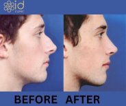 Before and after ultrasonic rhinoplasty results at ID Clinic Bangkok, improved nose profile