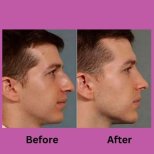 Before and after ultrasonic rhinoplasty results at ID Clinic Bangkok, improved nose profile