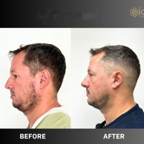 Before and after ultrasonic rhinoplasty result at ID Clinic Bangkok, improved nose profile