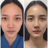 Before and after Asian rhinoplasty result at ID Clinic Bangkok, nose reshaping improvement