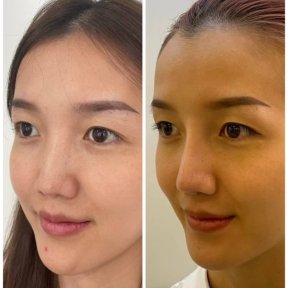 Asian rhinoplasty before and after results at ID Clinic Bangkok, nose reshaping improvement