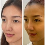 Asian rhinoplasty before and after results at ID Clinic Bangkok, nose reshaping improvement