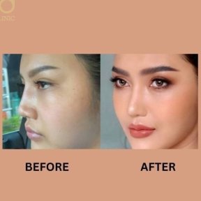 Before and after Asian rhinoplasty results at ID Clinic Bangkok, refined nose contour visible