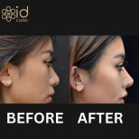 Before and after Asian rhinoplasty results at ID Clinic Bangkok, nose reshaping improvement