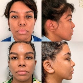 Vorher-nachher-Ergebnisse Facelift bei ID Clinic Bangkok, verbesserte Gesichtskontur