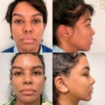 Vorher-nachher-Ergebnisse Facelift bei ID Clinic Bangkok, verbesserte Gesichtskontur