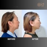 Facelift Vorher-Nachher-Ergebnisse bei ID Clinic Bangkok, verbesserte Gesichtskontur