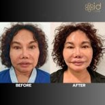 Vorher-nachher-Ergebnis Facelift bei ID Clinic Bangkok, sichtbare Verjüngung und Straffung