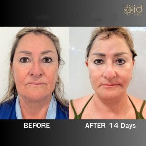Facelift Vorher-Nachher-Ergebnis bei ID Clinic Bangkok, sichtbare Verjüngung nach 14 Tagen