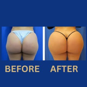 Vorher-nachher-Ergebnis Po-Lifting bei ID Clinic Bangkok, verbesserte Form und Volumen