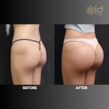 Vorher-nachher-Ergebnis Po-Lifting bei ID Clinic Bangkok, verbesserte Form und Volumen